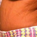 swollen!!!!! but getting flatter everyday