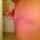Lt. view of scar 12 wks., 4 days post op.