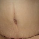 Day 21 post-op.