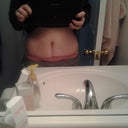 5 weeks post op