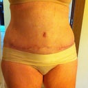 4 wks post-op.