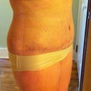 4 wks post-op.  Still a lot of swelling.