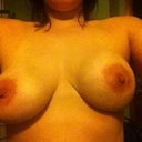 Capsular Contracture, in my Left side.  My Right boob is 'normal' and what they both used to look like.  This is a few months before explant.
