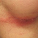 Allergic Reaction to Bacitracin