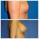 Before and after