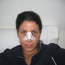 So here it is... me, the day after surgery. I get a lot of questions about the cast, bruising, going out in public etc. Decide for yourself! lol. Needless to say, I chose NOT to go out of the house :)