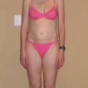 Before Thermage