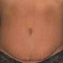 After TT- Front (6mths)