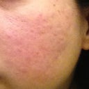 Before procedure
