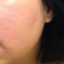 Day 4 after procedure - it already looks great!
