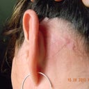 Behind left ear. Not as bad looking but the lump from the scar hurts when touched.