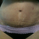 19 days PO swelled but better... scar right above pink lace.. barely shows.. y r my pics upside down???