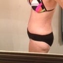 after @ 12 days post surgery
