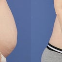 2 months post op