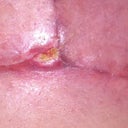 Incision tear