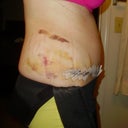 right side... SUPER bruised