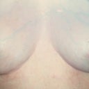Reconstruction Dr. Berman June 2009
WIth the 'pocket protectors' & he did an amazing scar revision at the same time. 34B