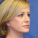 Middle Age Woman Treated With Perma-Lift Facelift And Necklift.