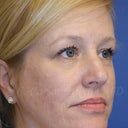 Middle Age Woman Treated With Perma-Lift Facelift And Necklift.