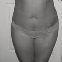 3 day post op