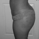 3 day post op