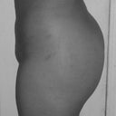 12 day post op