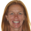 45 Year Old Female Open Bite, Treatment With Orthognathic Surgery And Braces