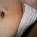 POD7 swelling more and more, peek at scar, first drain taken out, BB sutures removed