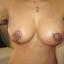 day 17 breast. my left side is more swollen then the right. I had a scar cap removed from previous surgery.