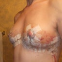 day 3 post explant first view without bra. I like!!!