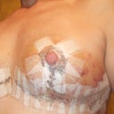 close up on tape and anchor scar