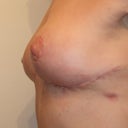 side view 2 weeks post lift and explant