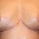 front view 2 weeks explant and lift.