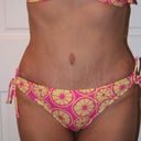 6 month post op.