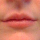 Over a year after the injection