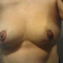 6 weeks happy with results