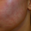 12 days after treatment
