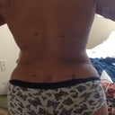 1 day post op- back view, no rolls lol
