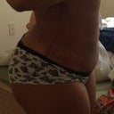 1 day post op- swelling like crazy