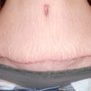 11 weeks post op.....going in next month and they will remove more skin and bring the scar down as well....