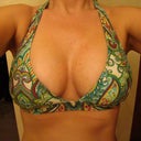 3 months post-op in my swimsuit.