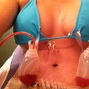postop day two or three
475ml saline implants with tummy tuck