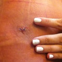 One side of stitches. Honestly, a little bigger and higher on my waist than I expected, but still not bad. I just kinda wish it was lower on my hips (underwear line). I just have to make sure to put lots of scar cream on them after it heals.