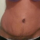 5 weeks post op insision