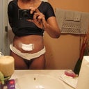 3 days post op