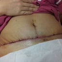 7 days post op.............. front view. OMG this is exactly a week ago, still very very swollen but looking good!