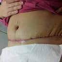 Bit wrinkled at the side, but have been told that once the swelling goes down so will the wrinkled bits.