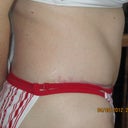 4 months post- op right side view