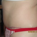 4 months post-op. left side scar shows a bit higher on this side but will hopefully fade more