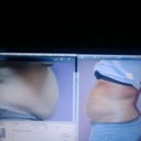 before surgery = 2 weeks out